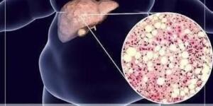 Severek yiyoruz ama karaciğeri bitiriyor!